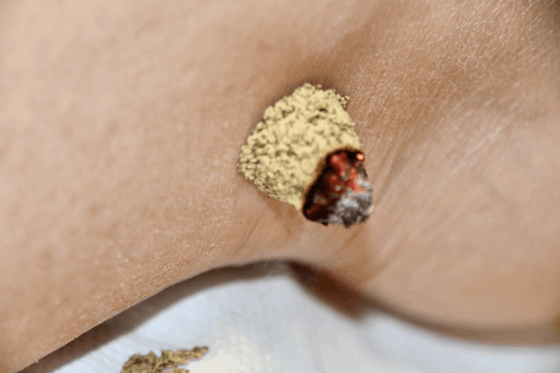 Moxibustion japonaise pour les douleurs 