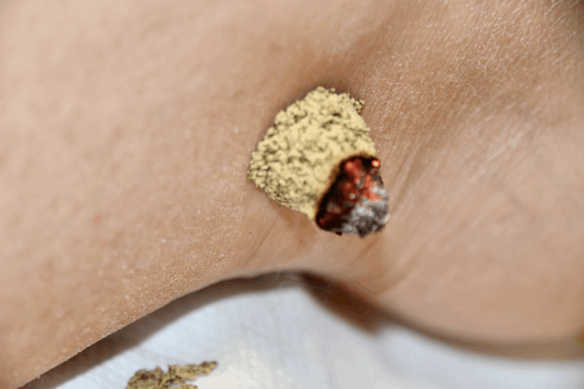 Moxibustion japonaise pour les douleurs 
