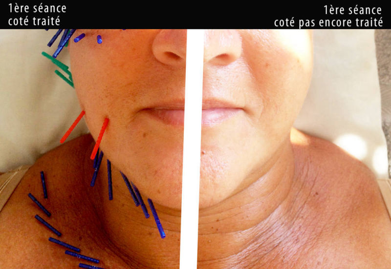 Lifting visage acupuncture style Corée