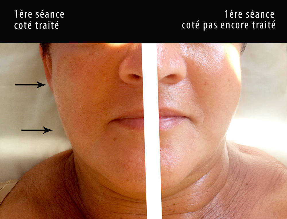 Lifting visage acupuncture coréenne