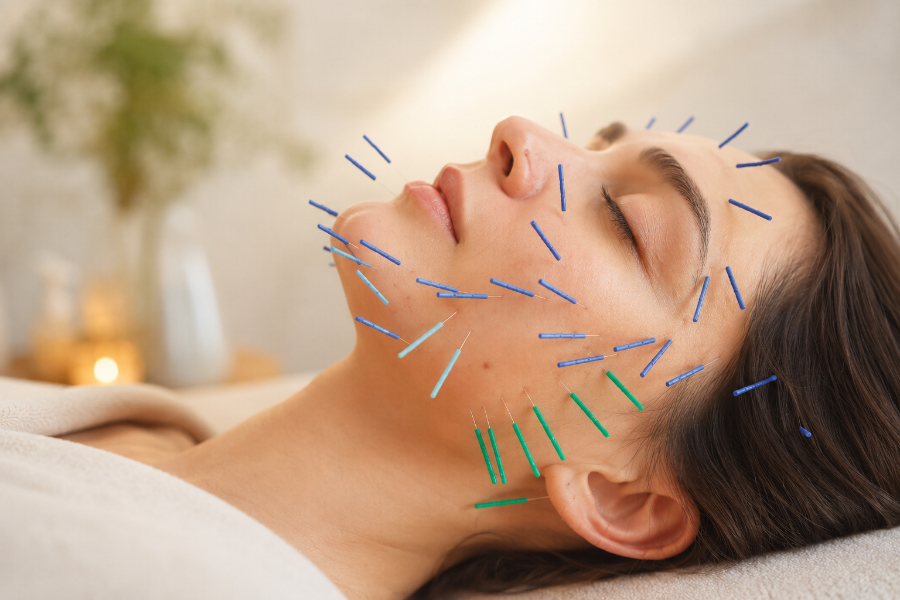 Acupuncture esthétique visage — lifting naturel Marseille